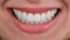 Depois - Dente Escurecido